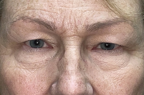 Upper Lid Blepharoplasty (upper eyelid lift)