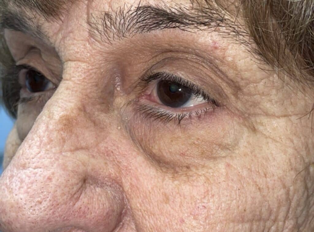 Upper Lid Blepharoplasty (upper eyelid lift)