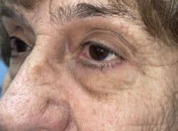 Upper Lid Blepharoplasty (upper eyelid lift)