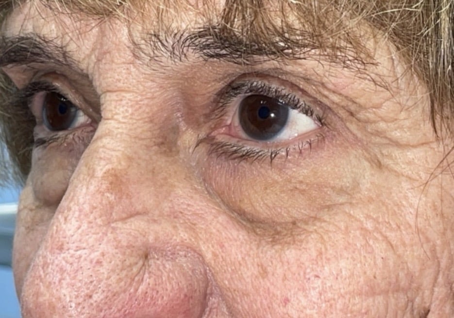 Upper Lid Blepharoplasty (upper eyelid lift)