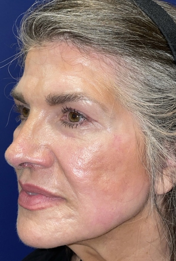 CO2 Laser Resurfacing (wrinkle/line reduction)