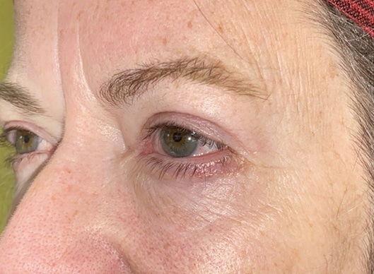 Combination Surgeries (eyelid lift and other)