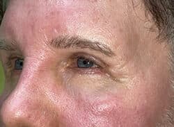 Combination Surgeries (eyelid lift and other)