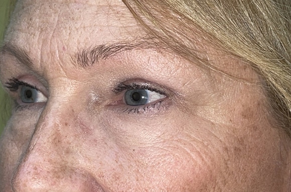 Upper Lid Blepharoplasty (upper eyelid lift)
