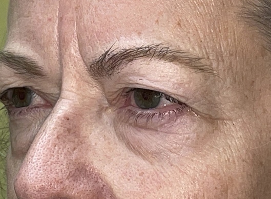 Combination Surgeries (eyelid lift and other)
