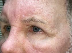 Combination Surgeries (eyelid lift and other)