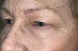 Upper Lid Blepharoplasty (upper eyelid lift)
