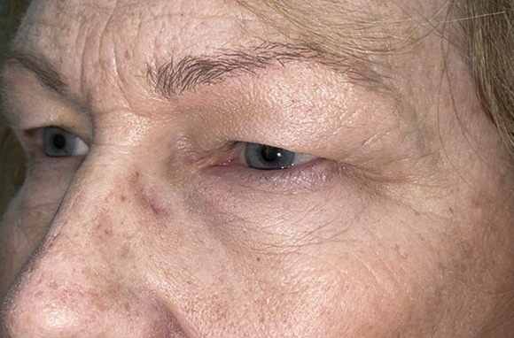 Upper Lid Blepharoplasty (upper eyelid lift)