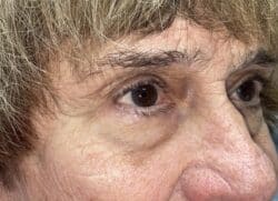 Upper Lid Blepharoplasty (upper eyelid lift)