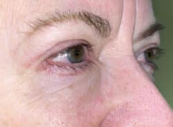 Combination Surgeries (eyelid lift and other)