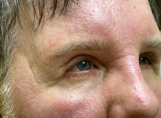 Combination Surgeries (eyelid lift and other)