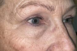 Upper Lid Blepharoplasty (upper eyelid lift)