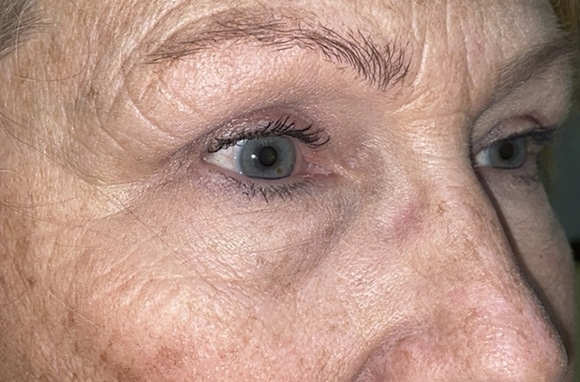 Upper Lid Blepharoplasty (upper eyelid lift)