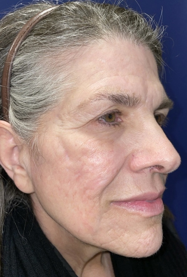 CO2 Laser Resurfacing (wrinkle/line reduction)