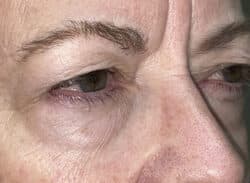 Combination Surgeries (eyelid lift and other)