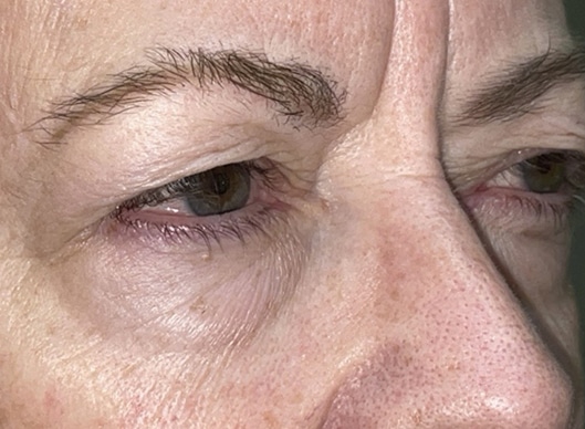 Combination Surgeries (eyelid lift and other)