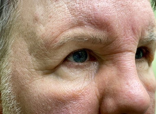 Combination Surgeries (eyelid lift and other)