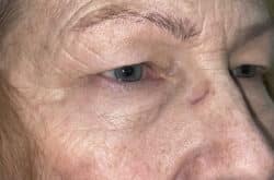 Upper Lid Blepharoplasty (upper eyelid lift)