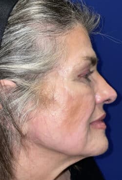 CO2 Laser Resurfacing (wrinkle/line reduction)