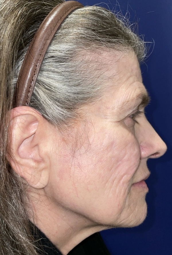 CO2 Laser Resurfacing (wrinkle/line reduction)