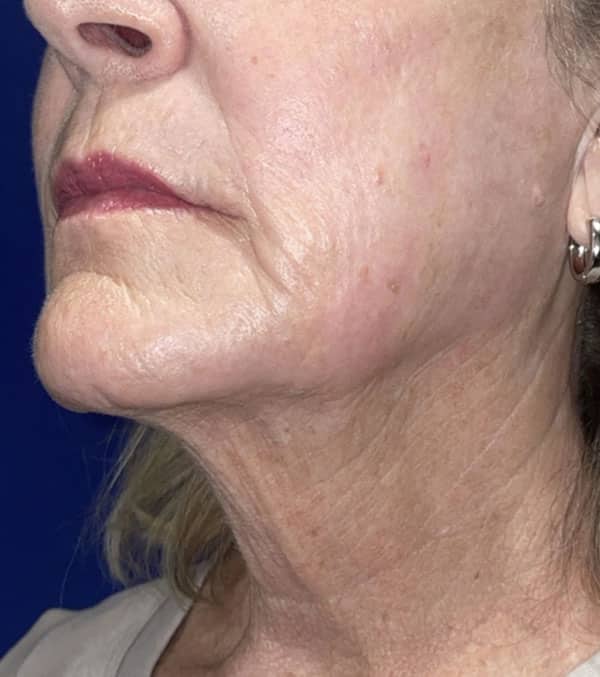 CO2 Laser Resurfacing (wrinkle/line reduction)