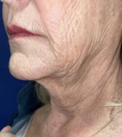 CO2 Laser Resurfacing (wrinkle/line reduction)