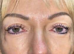 Combination Surgeries (eyelid lift and other)