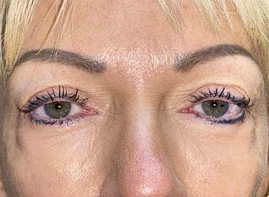 Combination Surgeries (eyelid lift and other)