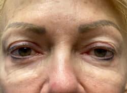 Combination Surgeries (eyelid lift and other)