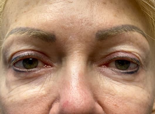 Combination Surgeries (eyelid lift and other)