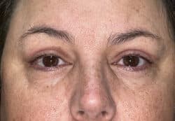 Upper/Lower Lid Blepharoplasty