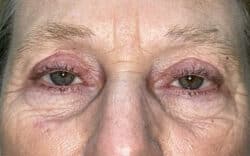 Eyelid Lift (Blepharoplasty/Ptosis Repair)