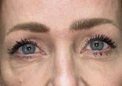 Brow/Forehead Lift