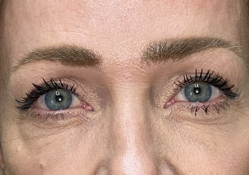 Brow/Forehead Lift