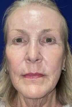 CO2 Laser Resurfacing (wrinkle/line reduction)