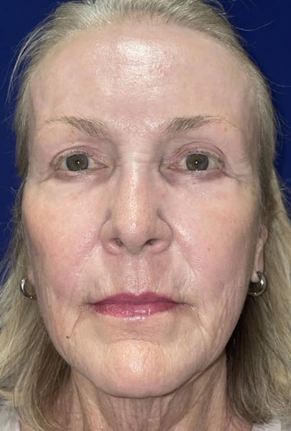 CO2 Laser Resurfacing (wrinkle/line reduction)