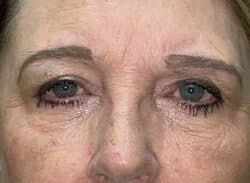 Combination Surgeries (eyelid lift and other)