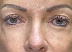 Combination Surgeries (eyelid lift and other)