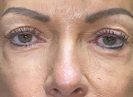 Combination Surgeries (eyelid lift and other)