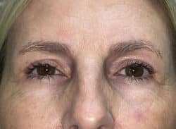 Combination Surgeries (eyelid lift and other)