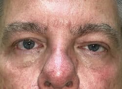 Combination Surgeries (eyelid lift and other)