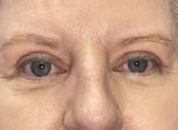 Combination Surgeries (eyelid lift and other)