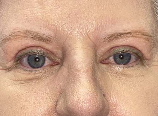 Combination Surgeries (eyelid lift and other)