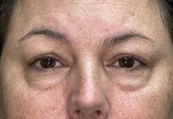 Upper/Lower Lid Blepharoplasty
