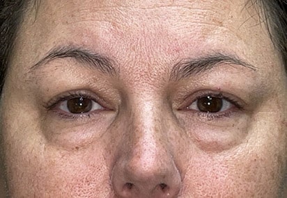 Upper/Lower Lid Blepharoplasty