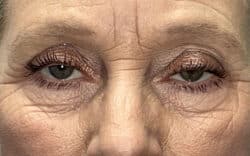 Eyelid Lift (Blepharoplasty/Ptosis Repair)