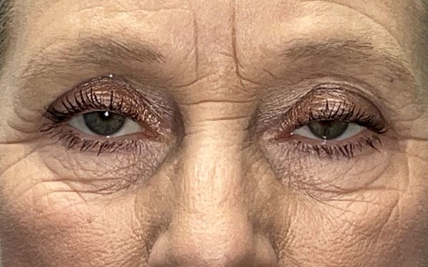Eyelid Lift (Blepharoplasty/Ptosis Repair)