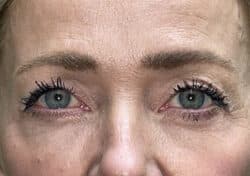Brow/Forehead Lift