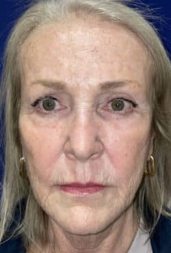 CO2 Laser Resurfacing (wrinkle/line reduction)