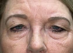 Combination Surgeries (eyelid lift and other)